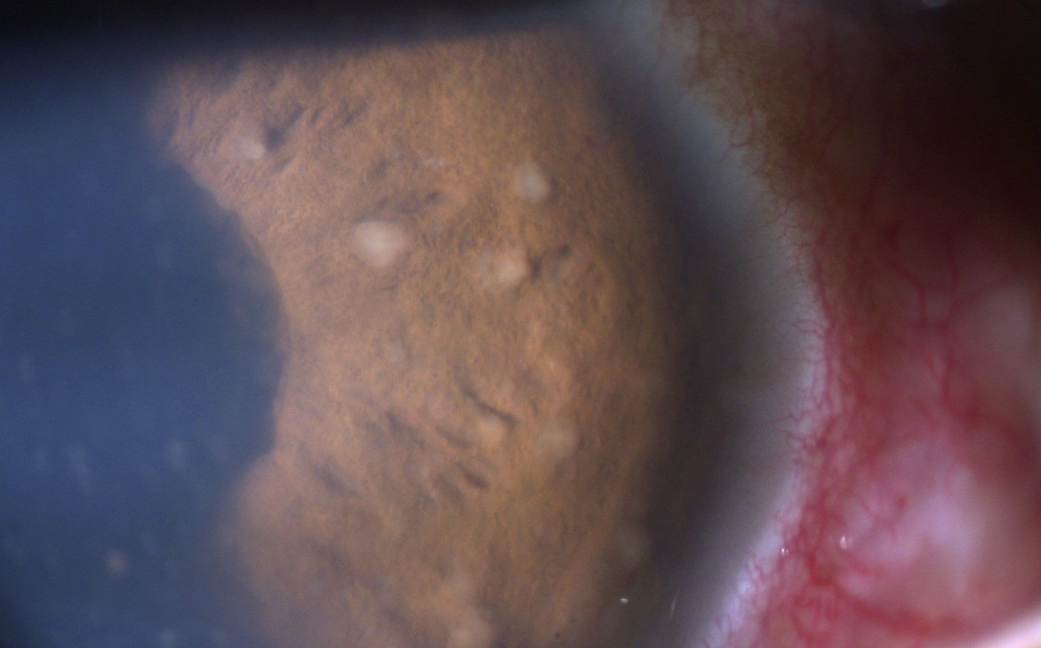 nodules de Busacca iriens chez un patient avec panuvéite sarcoïdosique